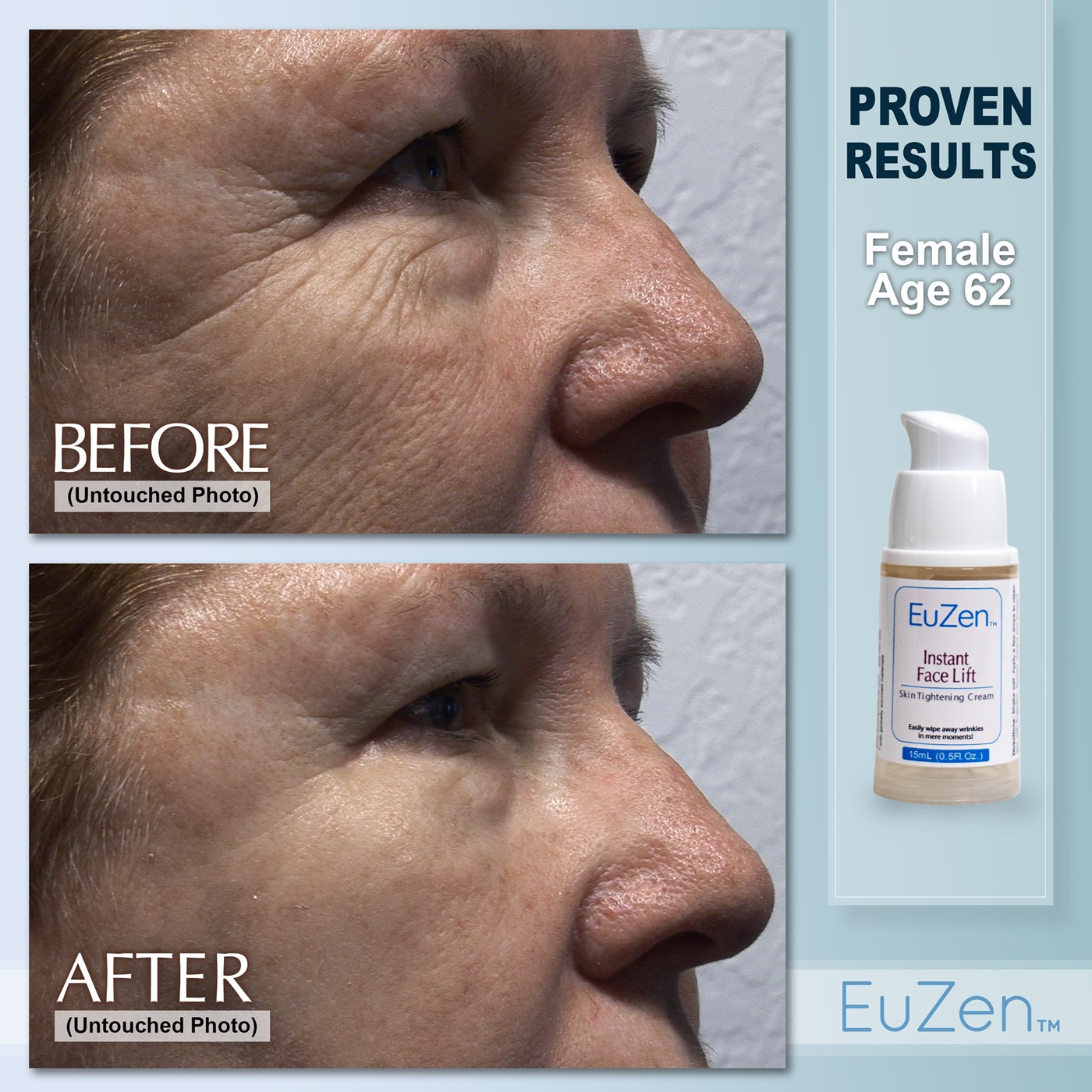 Woman, age 62, before and after EuZen application