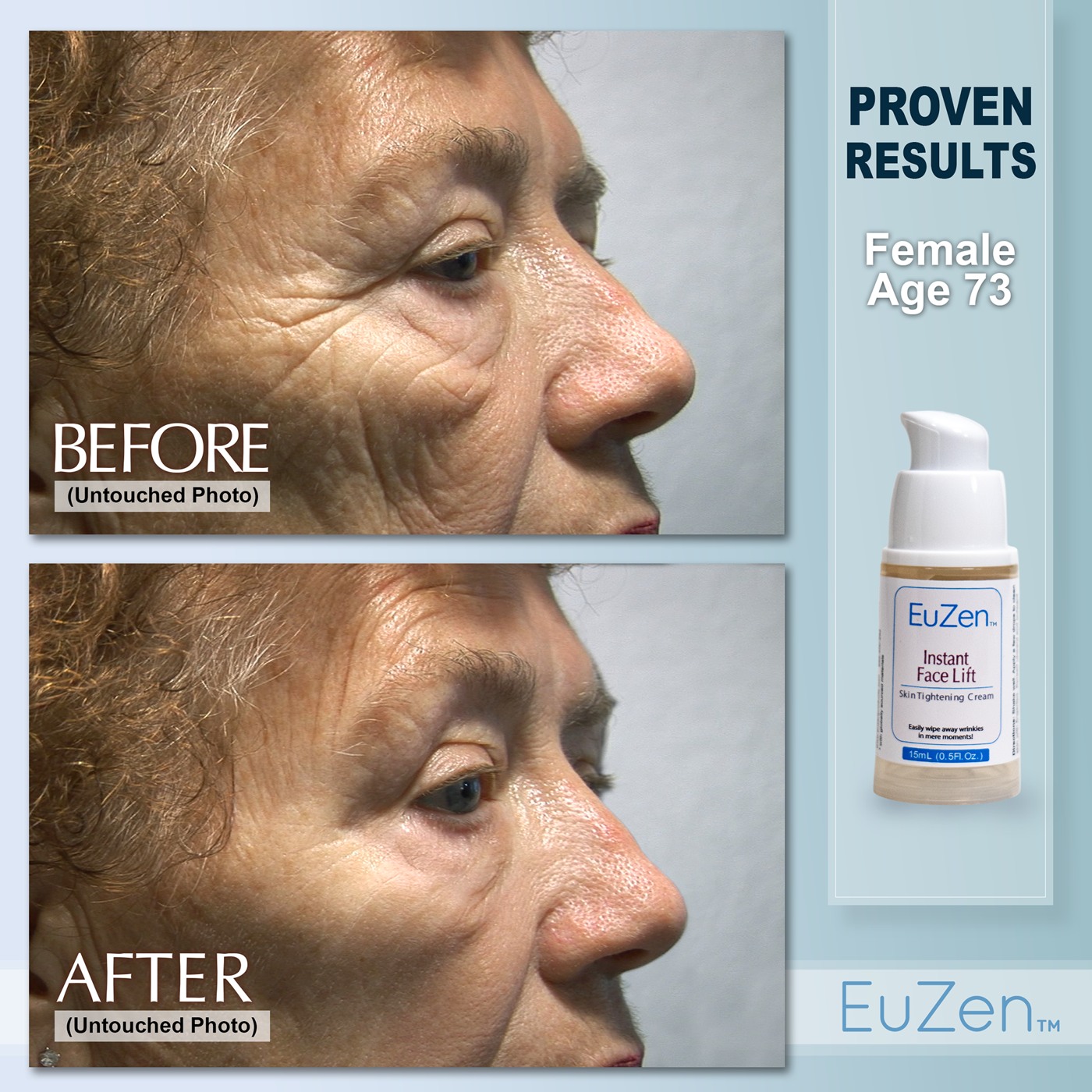 Woman, age 73, before and after EuZen application